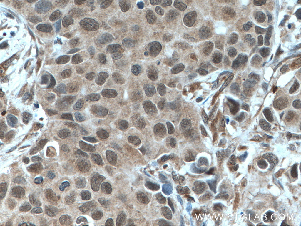 Immunohistochemistry (IHC) staining of human breast cancer tissue using mTOR Polyclonal antibody (20657-1-AP)