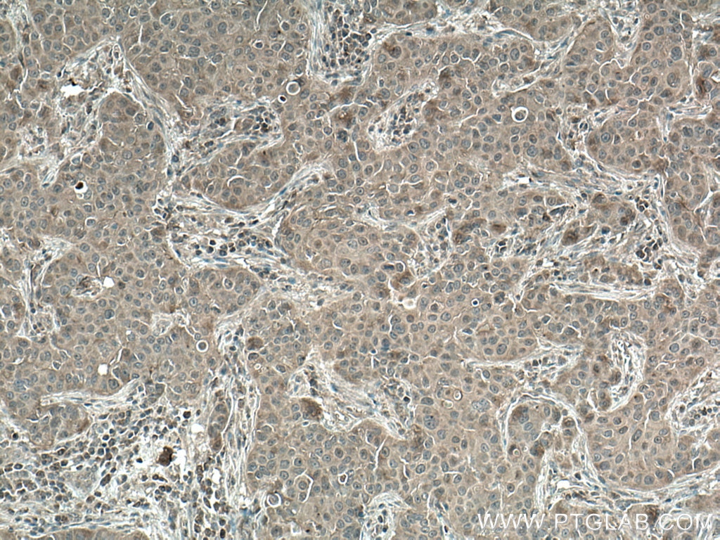 Immunohistochemistry (IHC) staining of human breast cancer tissue using mTOR Polyclonal antibody (28273-1-AP)