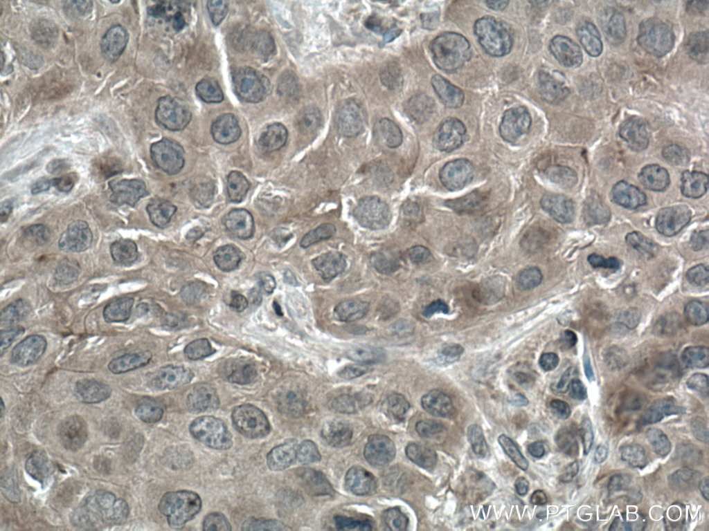 Immunohistochemistry (IHC) staining of human breast cancer tissue using mTOR Polyclonal antibody (28273-1-AP)