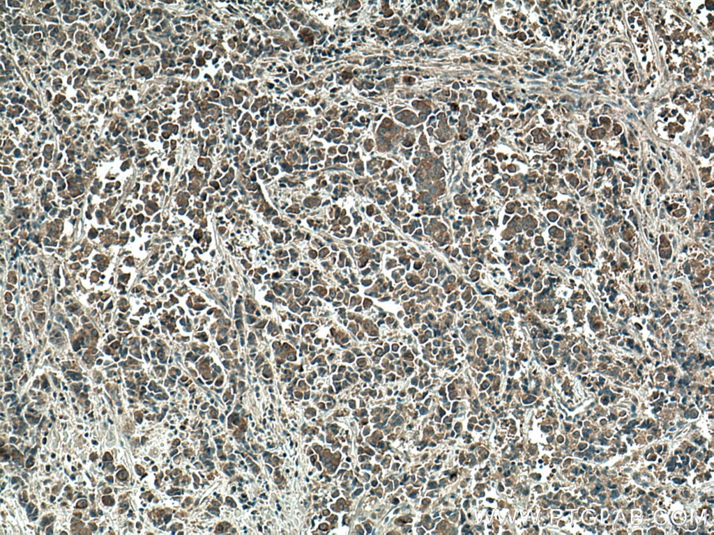 Immunohistochemistry (IHC) staining of human prostate cancer tissue using mTOR Polyclonal antibody (28273-1-AP)