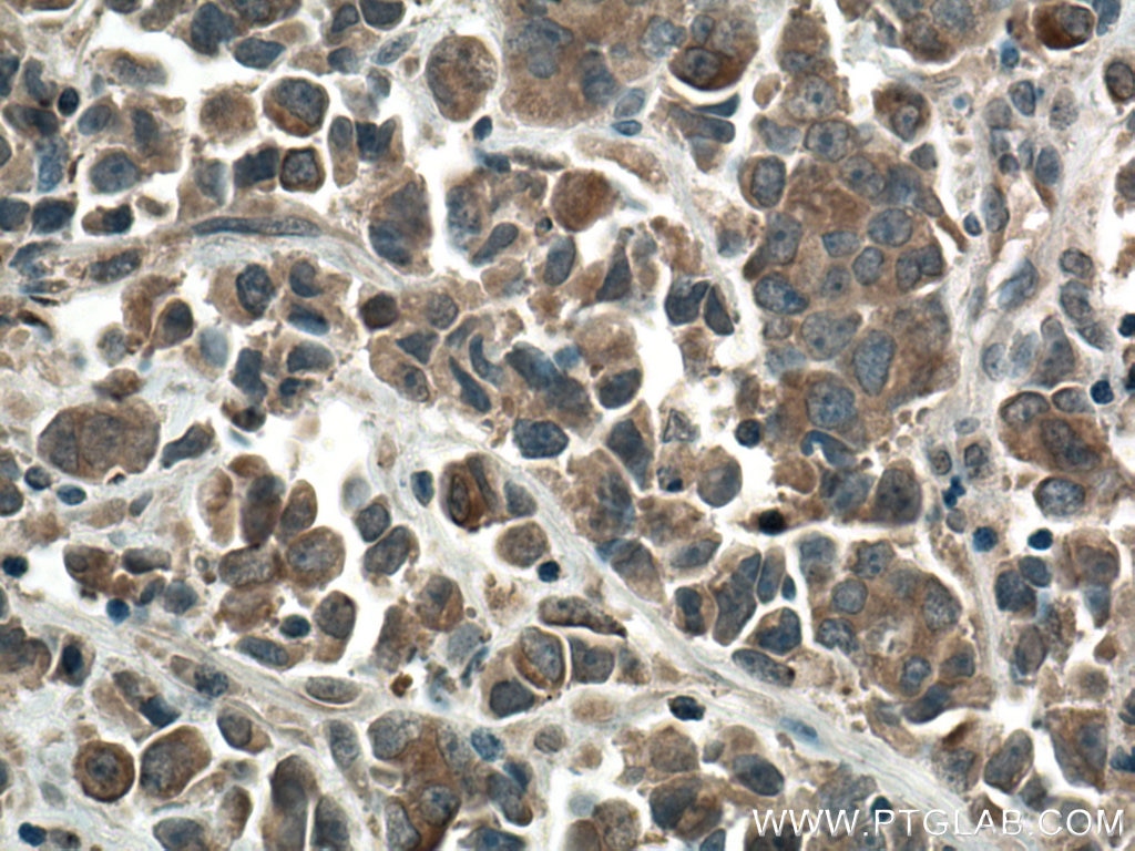 IHC staining of human prostate cancer using 28273-1-AP
