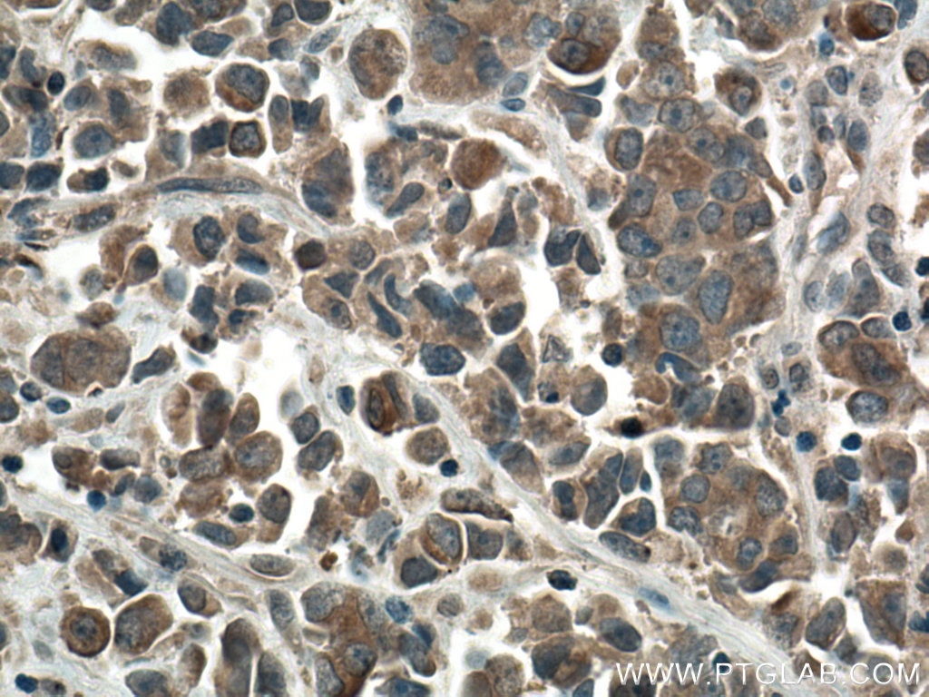 Immunohistochemistry (IHC) staining of human prostate cancer tissue using mTOR Polyclonal antibody (28273-1-AP)