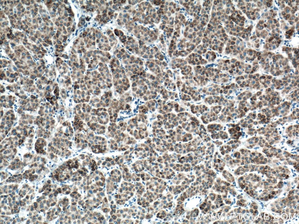 Immunohistochemistry (IHC) staining of human liver cancer tissue using mTOR Monoclonal antibody (66888-1-Ig)