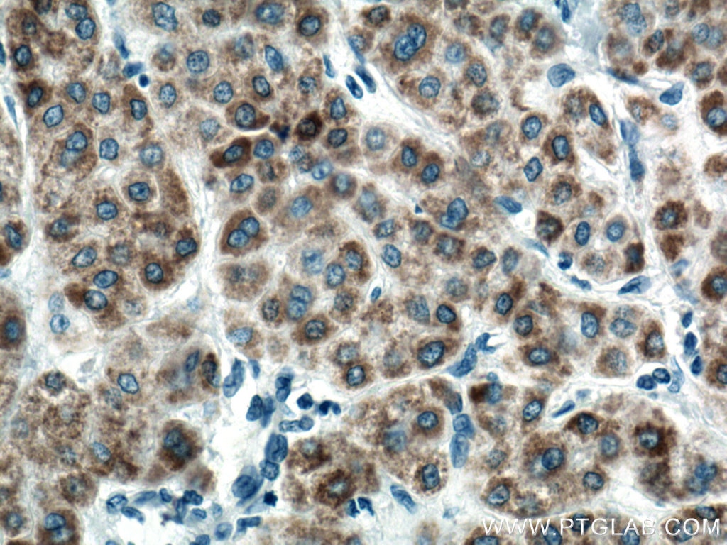 Immunohistochemistry (IHC) staining of human liver cancer tissue using mTOR Monoclonal antibody (66888-1-Ig)