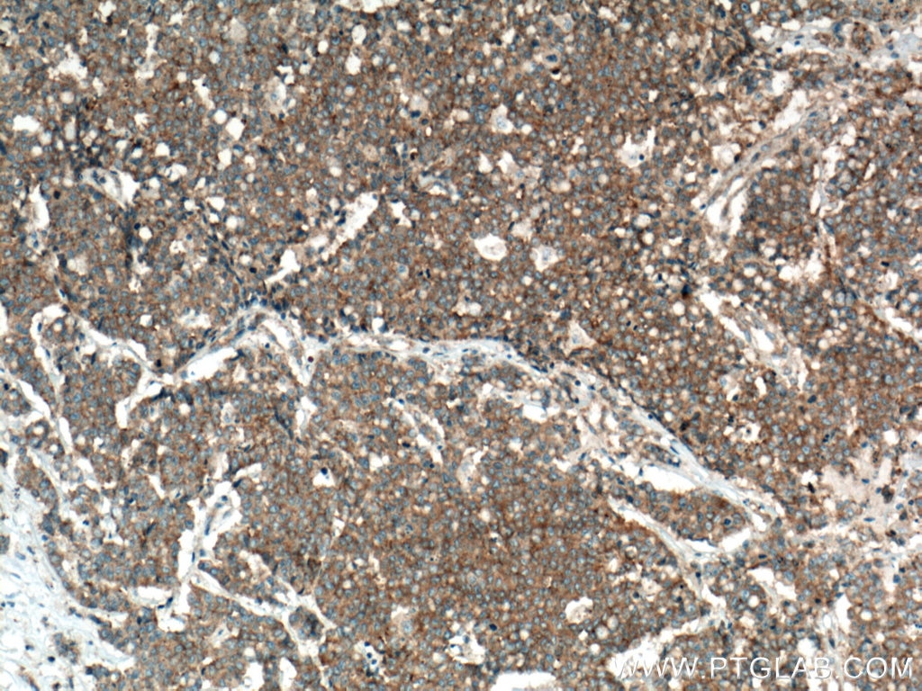 Immunohistochemistry (IHC) staining of human colon cancer tissue using mTOR Monoclonal antibody (66888-1-Ig)