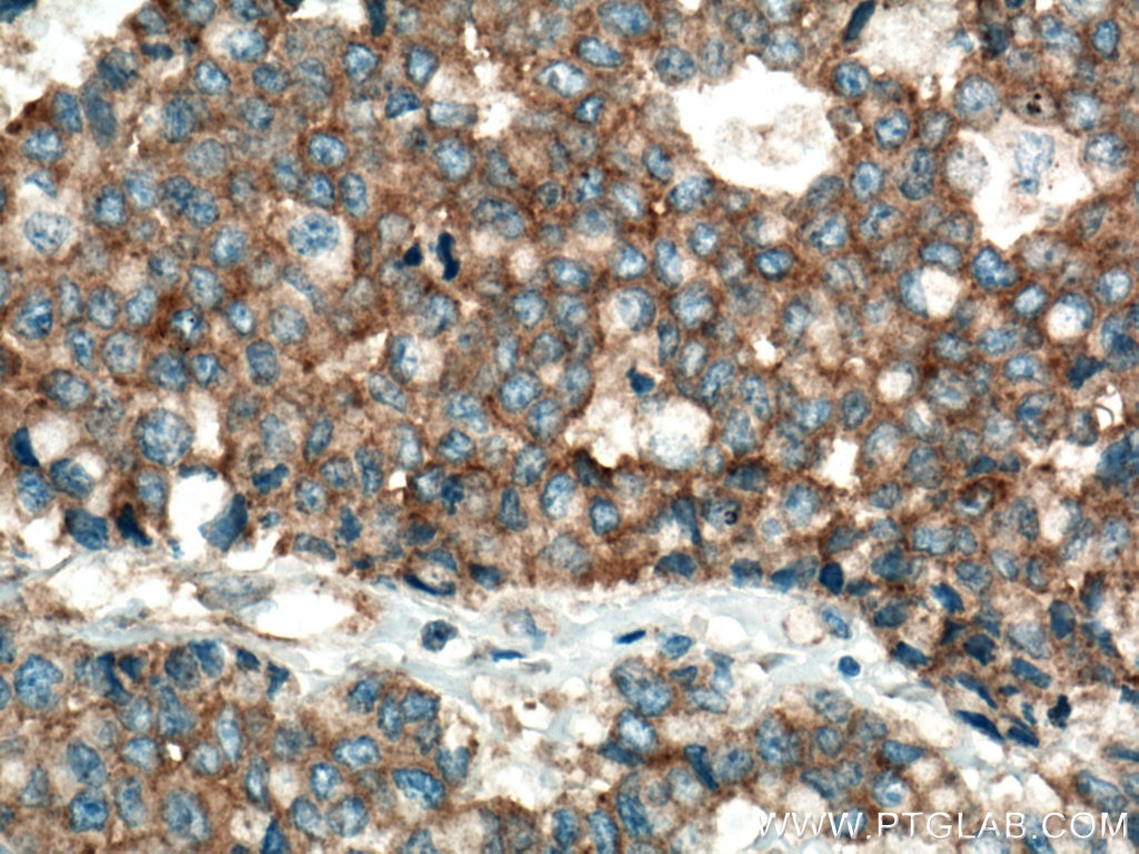Immunohistochemistry (IHC) staining of human colon cancer tissue using mTOR Monoclonal antibody (66888-1-Ig)