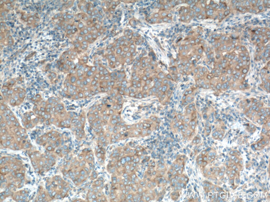 Immunohistochemistry (IHC) staining of human breast cancer tissue using mTOR Monoclonal antibody (66888-1-Ig)