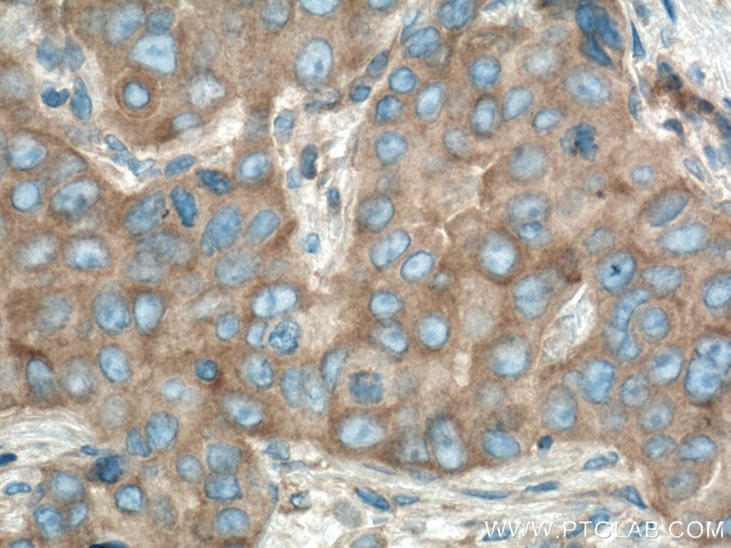 Immunohistochemistry (IHC) staining of human breast cancer tissue using mTOR Monoclonal antibody (66888-1-Ig)
