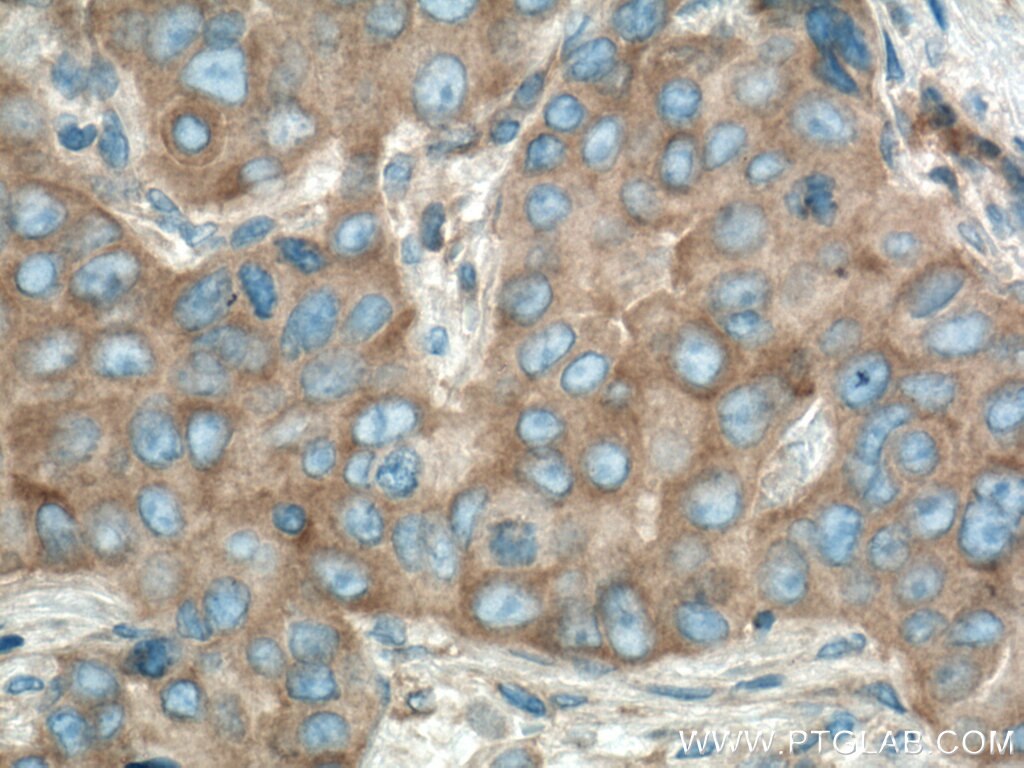 IHC staining of human breast cancer using 66888-1-Ig