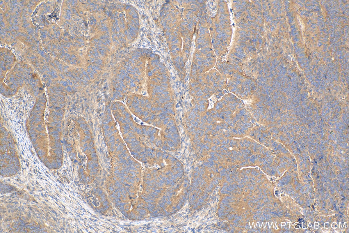 Immunohistochemical analysis of paraffin-embedded human colon cancer tissue slide using 81670-1-RR (mTOR antibody) at dilution of 1:200 (under 10x lens). Heat mediated antigen retrieval with Tris-EDTA buffer (pH 9.0). This data was developed using the same antibody clone with 81670-1-PBS in a different storage buffer formulation. Immunohistochemistry (IHC) staining of human colon cancer tissue using mTOR Recombinant monoclonal antibody (81670-1-RR)