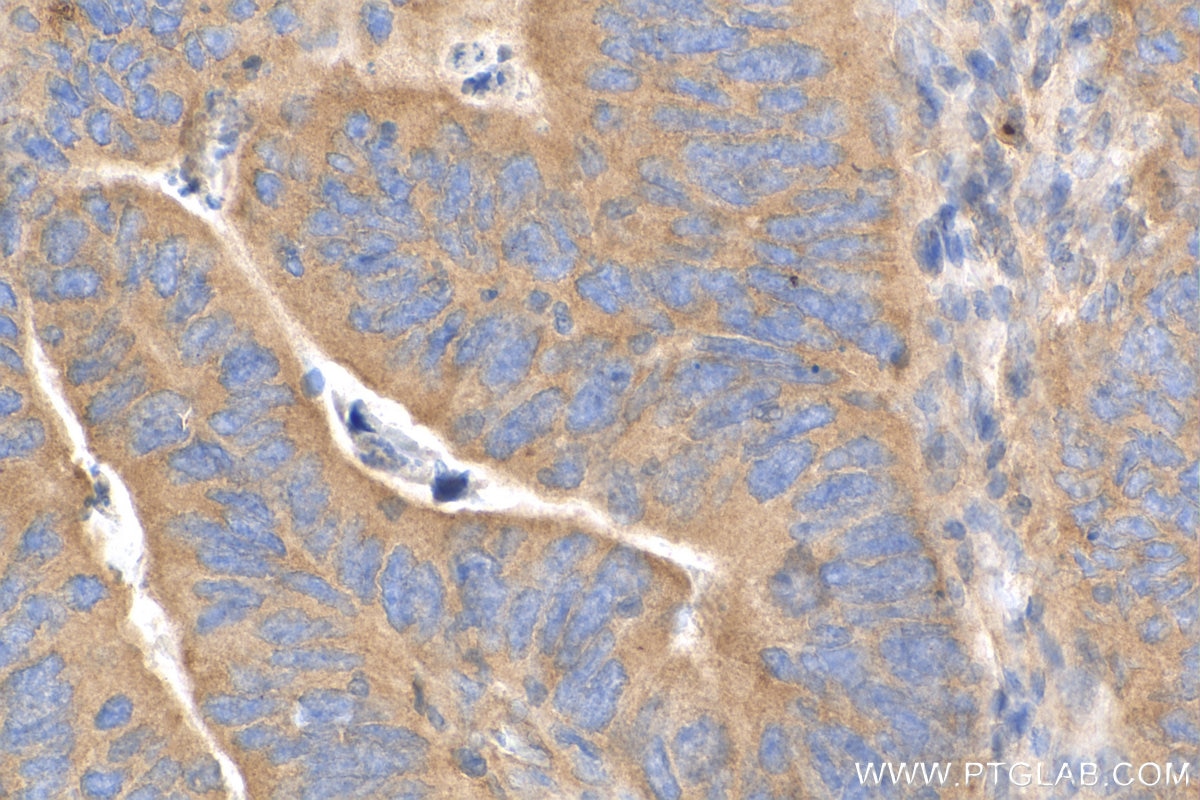 Immunohistochemistry (IHC) staining of human colon cancer tissue using mTOR Recombinant antibody (81670-1-RR)