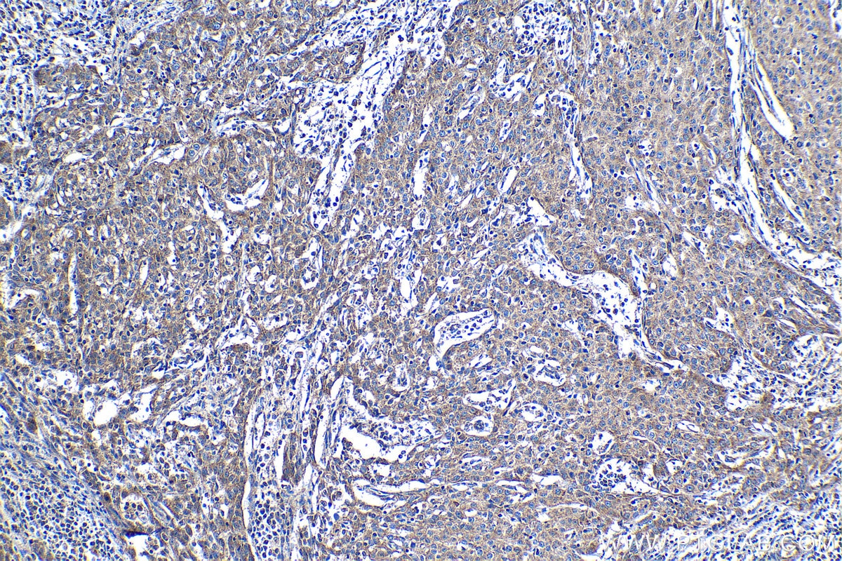Immunohistochemistry (IHC) staining of human cervical cancer tissue using MTR Polyclonal antibody (25896-1-AP)