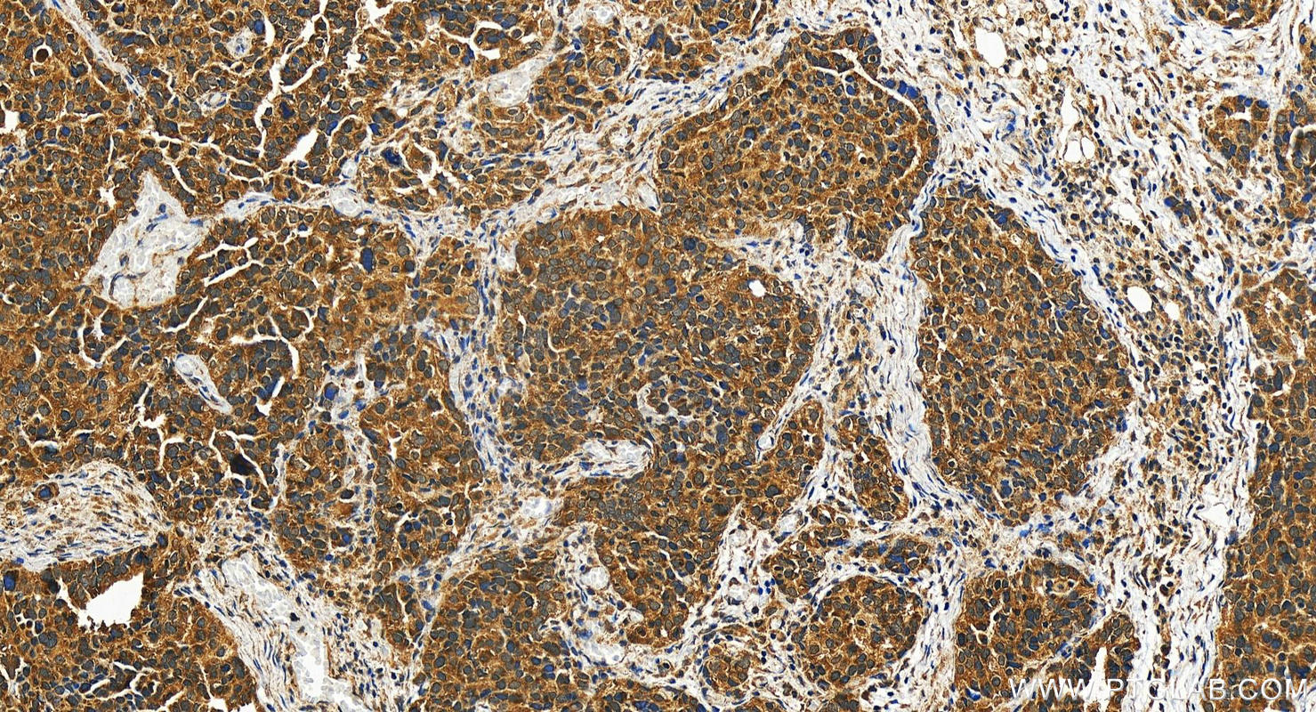 Immunohistochemistry (IHC) staining of human ovary cancer tissue using MTRR Polyclonal antibody (26944-1-AP)