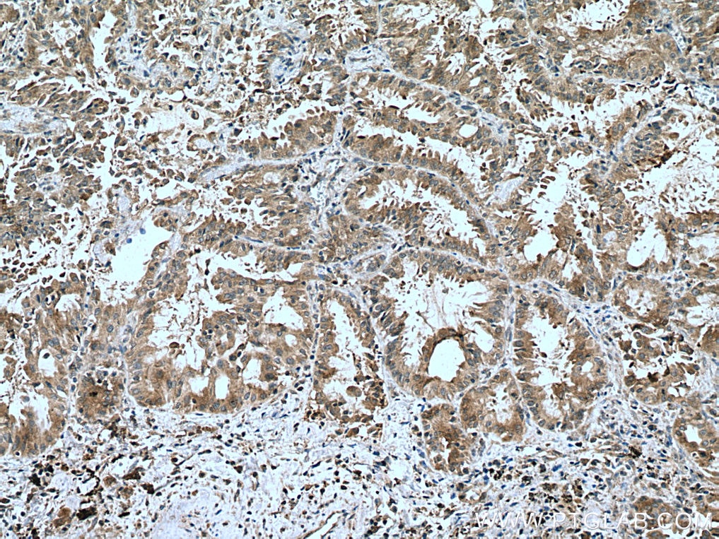 Immunohistochemistry (IHC) staining of human lung cancer tissue using MTSS1 Polyclonal antibody (13995-1-AP)