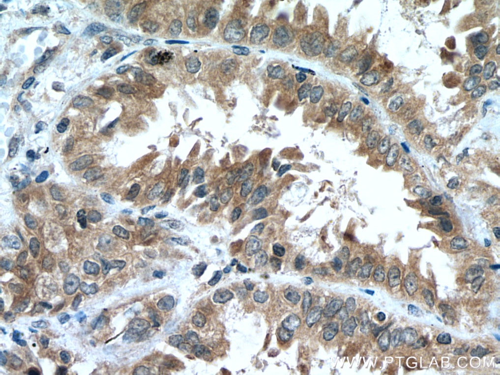 Immunohistochemistry (IHC) staining of human lung cancer tissue using MTSS1 Polyclonal antibody (13995-1-AP)
