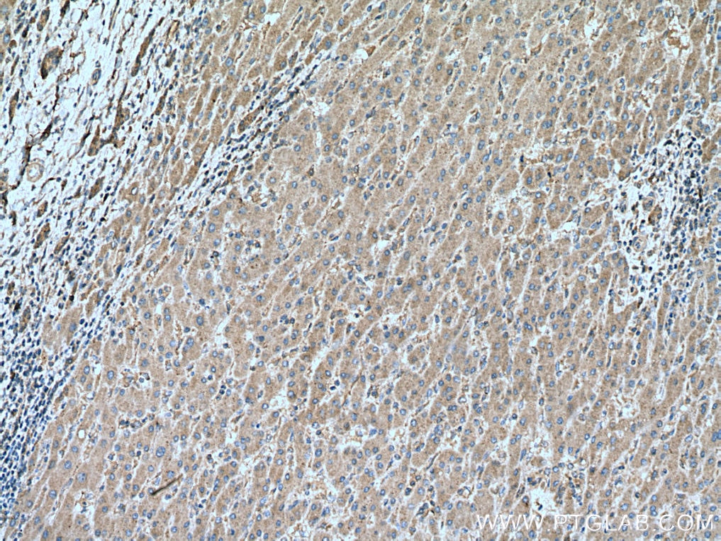 Immunohistochemistry (IHC) staining of human liver cancer tissue using MTSS1 Polyclonal antibody (13995-1-AP)