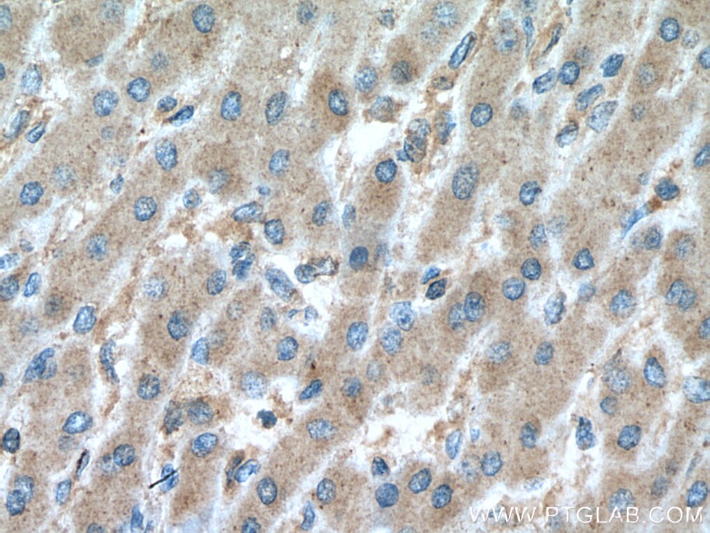 Immunohistochemistry (IHC) staining of human liver cancer tissue using MTSS1 Polyclonal antibody (13995-1-AP)
