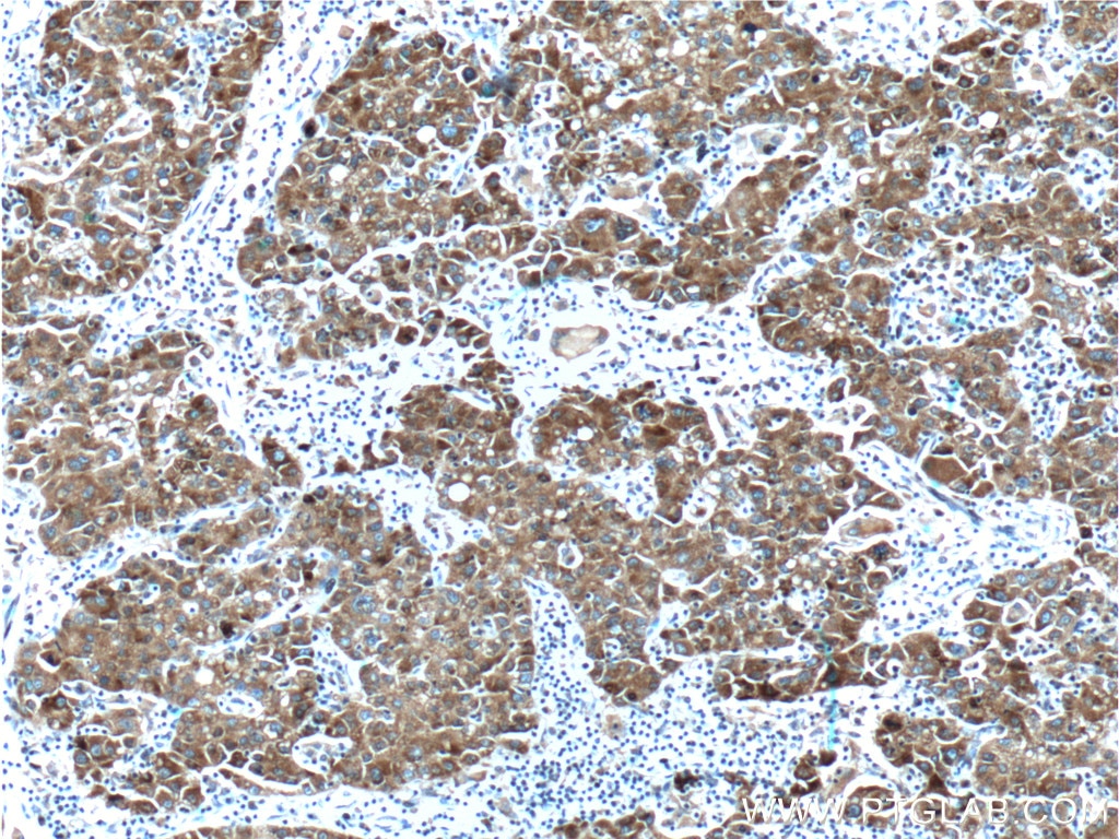 Immunohistochemistry (IHC) staining of human liver cancer tissue using MTTP Polyclonal antibody (23940-1-AP)