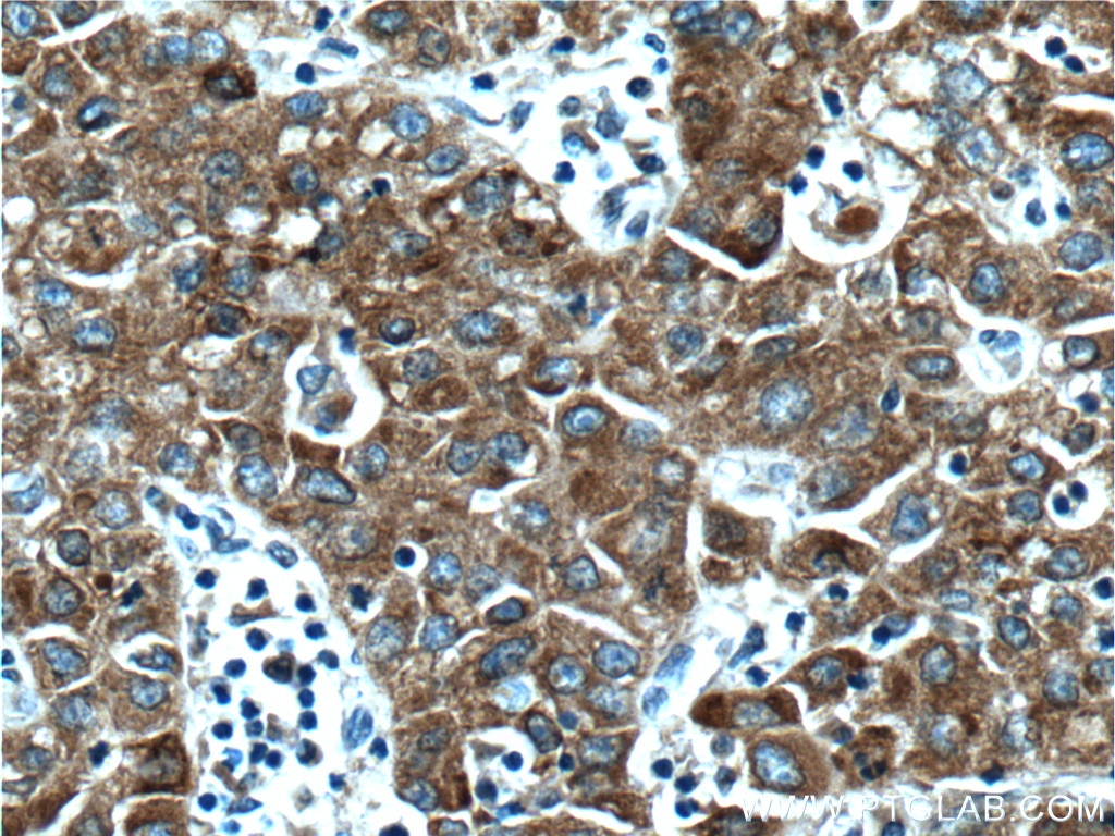 Immunohistochemistry (IHC) staining of human liver cancer tissue using MTTP Polyclonal antibody (23940-1-AP)