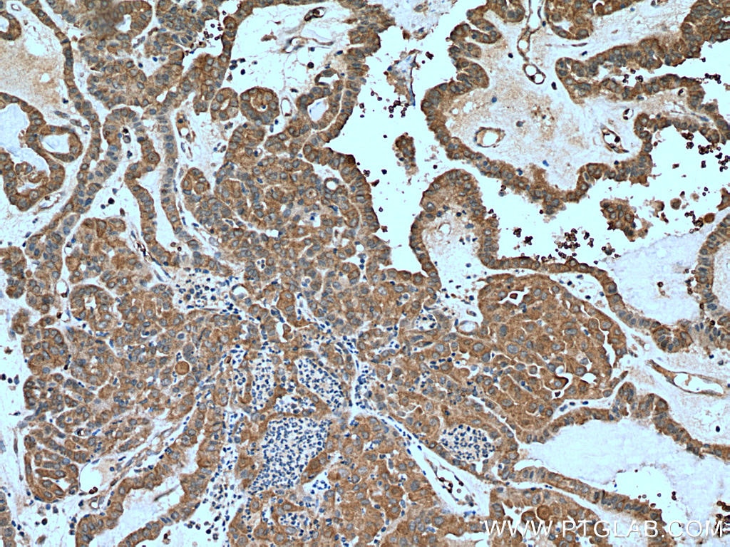 Immunohistochemistry (IHC) staining of human thyroid cancer tissue using MTUS1 Polyclonal antibody (13436-1-AP)