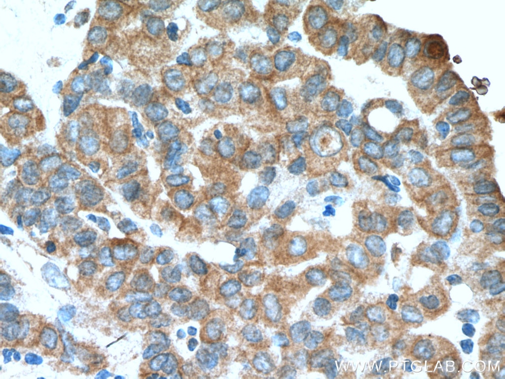 IHC staining of human thyroid cancer using 13436-1-AP