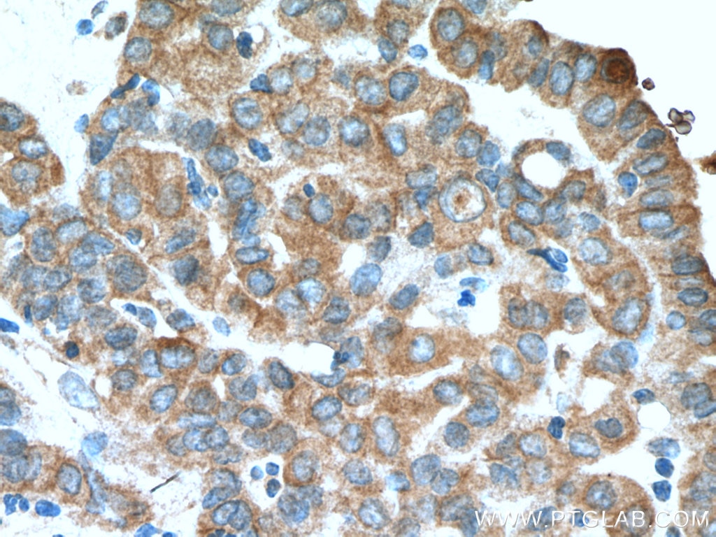 Immunohistochemistry (IHC) staining of human thyroid cancer tissue using MTUS1 Polyclonal antibody (13436-1-AP)