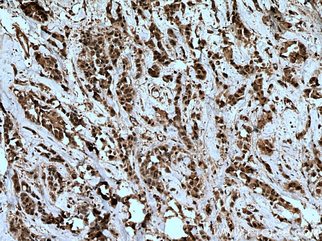 Immunohistochemistry (IHC) staining of human breast cancer tissue using MTUS1 Polyclonal antibody (13436-1-AP)