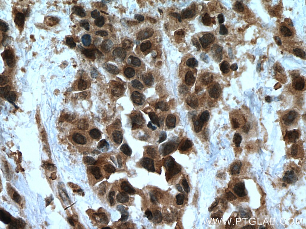 Immunohistochemistry (IHC) staining of human breast cancer tissue using MTUS1 Polyclonal antibody (13436-1-AP)