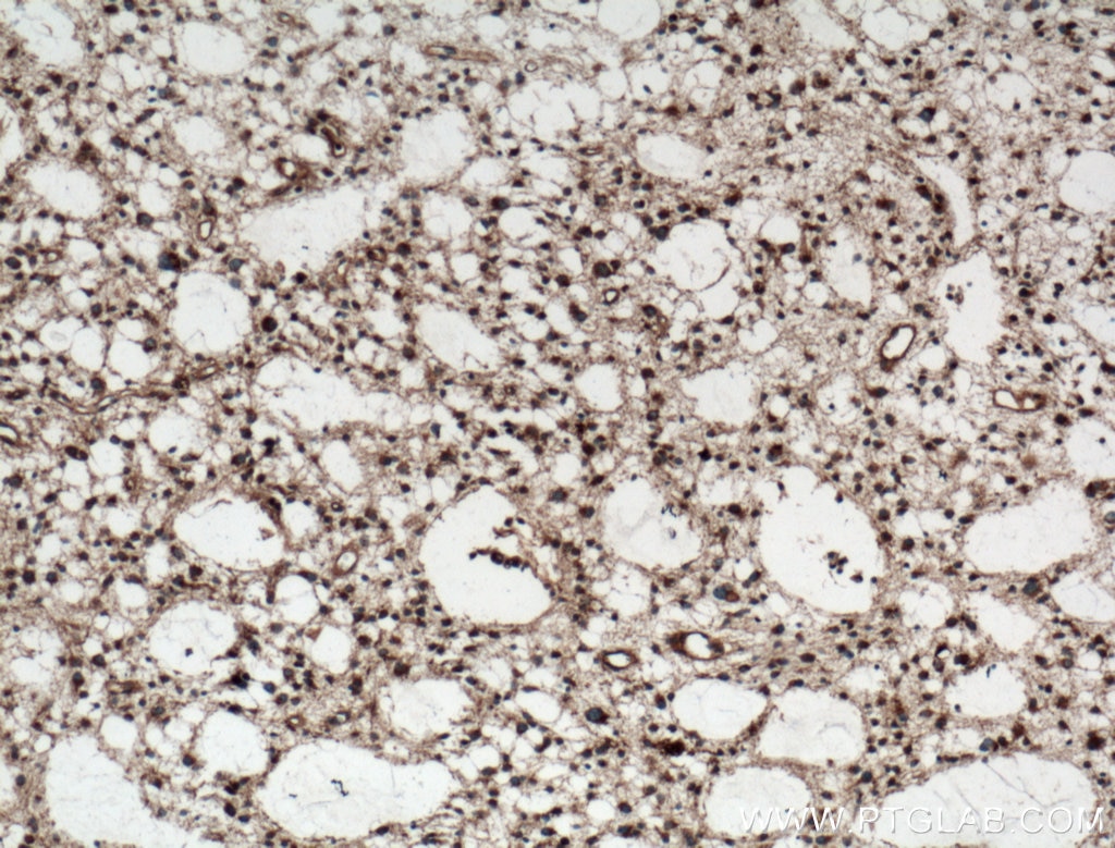 Immunohistochemistry (IHC) staining of human gliomas tissue using MTX2 Polyclonal antibody (11610-1-AP)