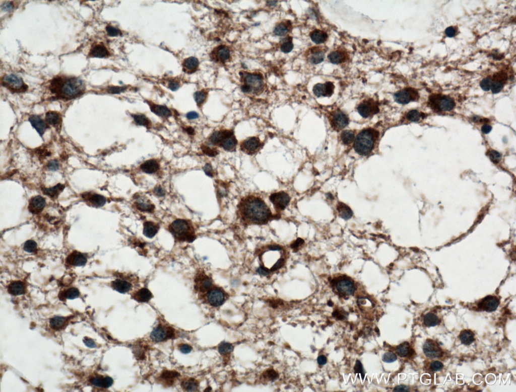 Immunohistochemistry (IHC) staining of human gliomas tissue using MTX2 Polyclonal antibody (11610-1-AP)