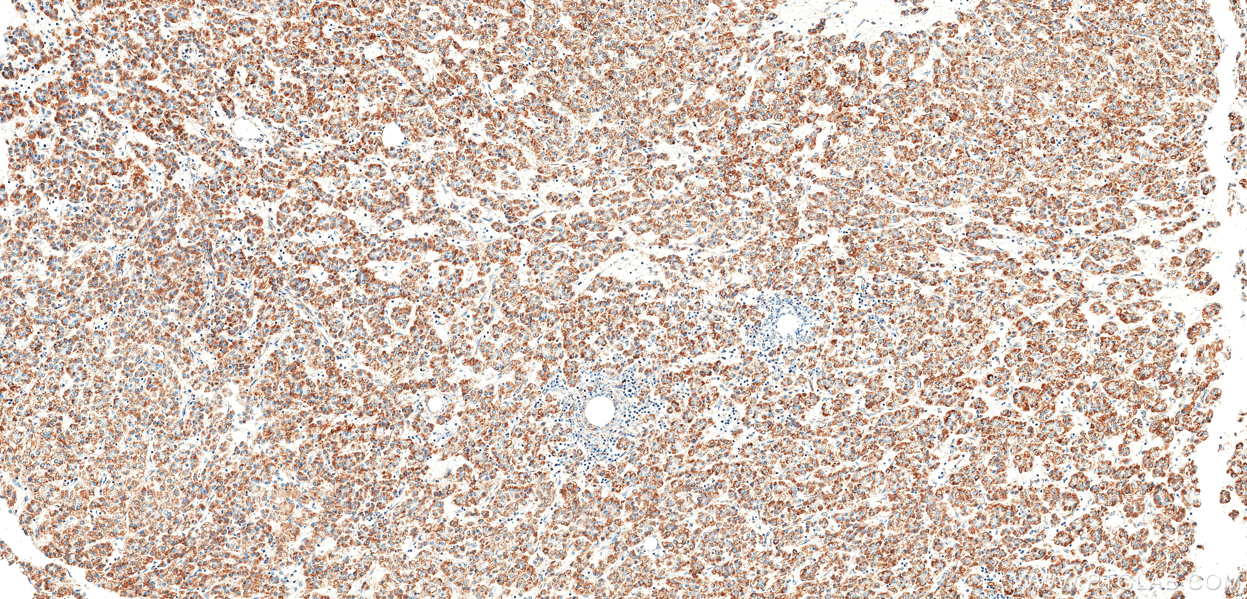 IHC staining of Human Hepatocellular cancer using 86899-1-RR (same clone as 86899-1-PBS) Immunohistochemistry (IHC) staining of Human Hepatocellular cancer using MTX2 Recombinant monoclonal antibody (86899-1-RR)