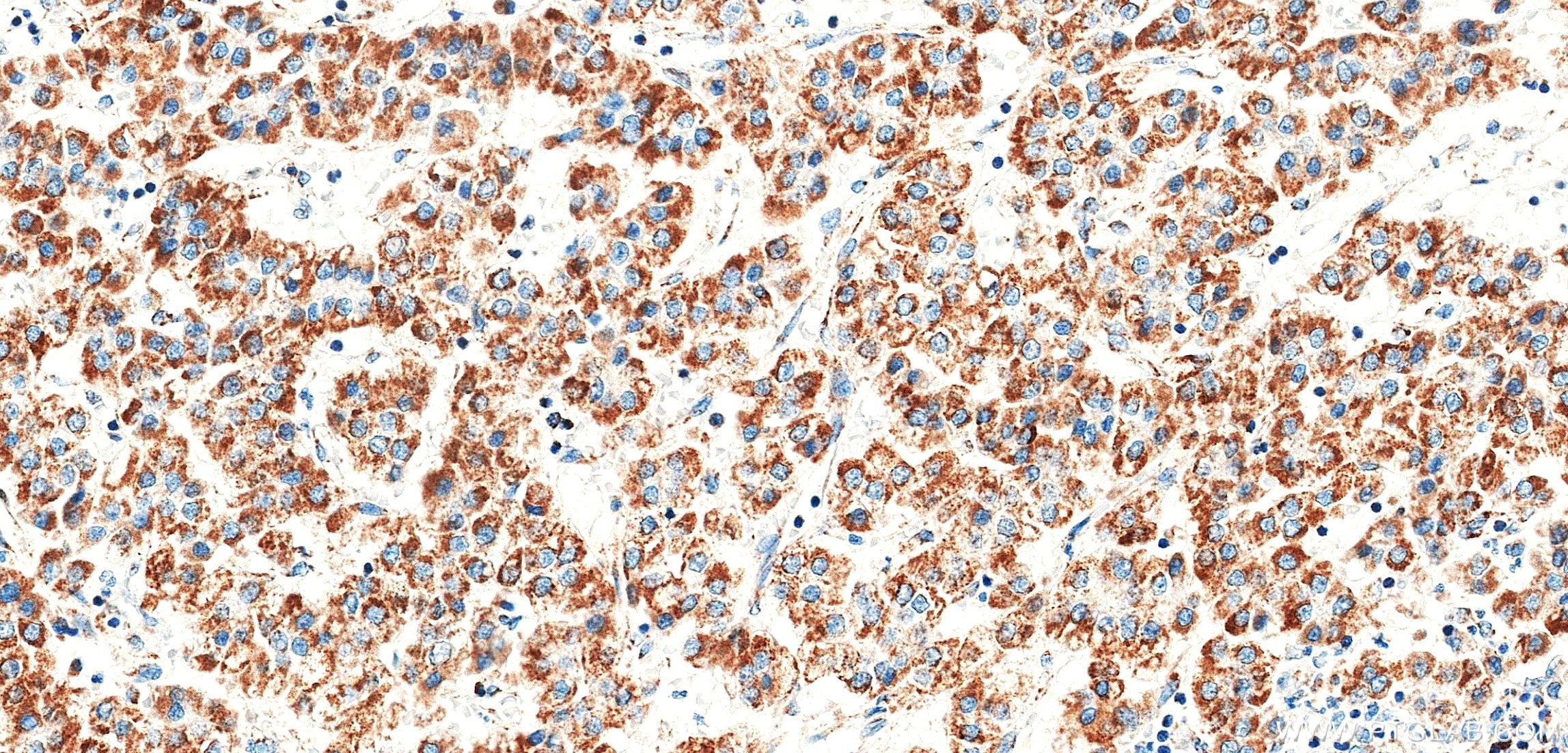 IHC staining of Human Hepatocellular cancer using 86899-1-RR (same clone as 86899-1-PBS) Immunohistochemistry (IHC) staining of Human Hepatocellular cancer using MTX2 Recombinant monoclonal antibody (86899-1-RR)