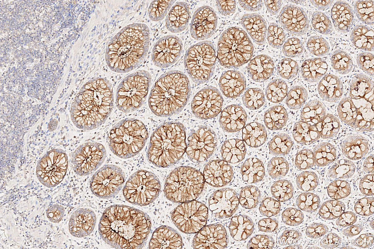 Immunohistochemistry (IHC) staining of human rectal cancer tissue using MUC1/CA15-3 Monoclonal antibody (60749-1-Ig)