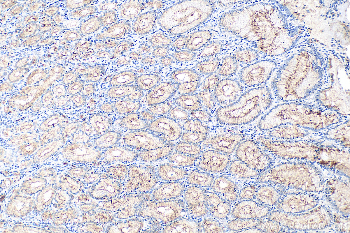 Immunohistochemistry (IHC) staining of human stomach cancer tissue using MUC1/CA15-3 Monoclonal antibody (60749-1-Ig)