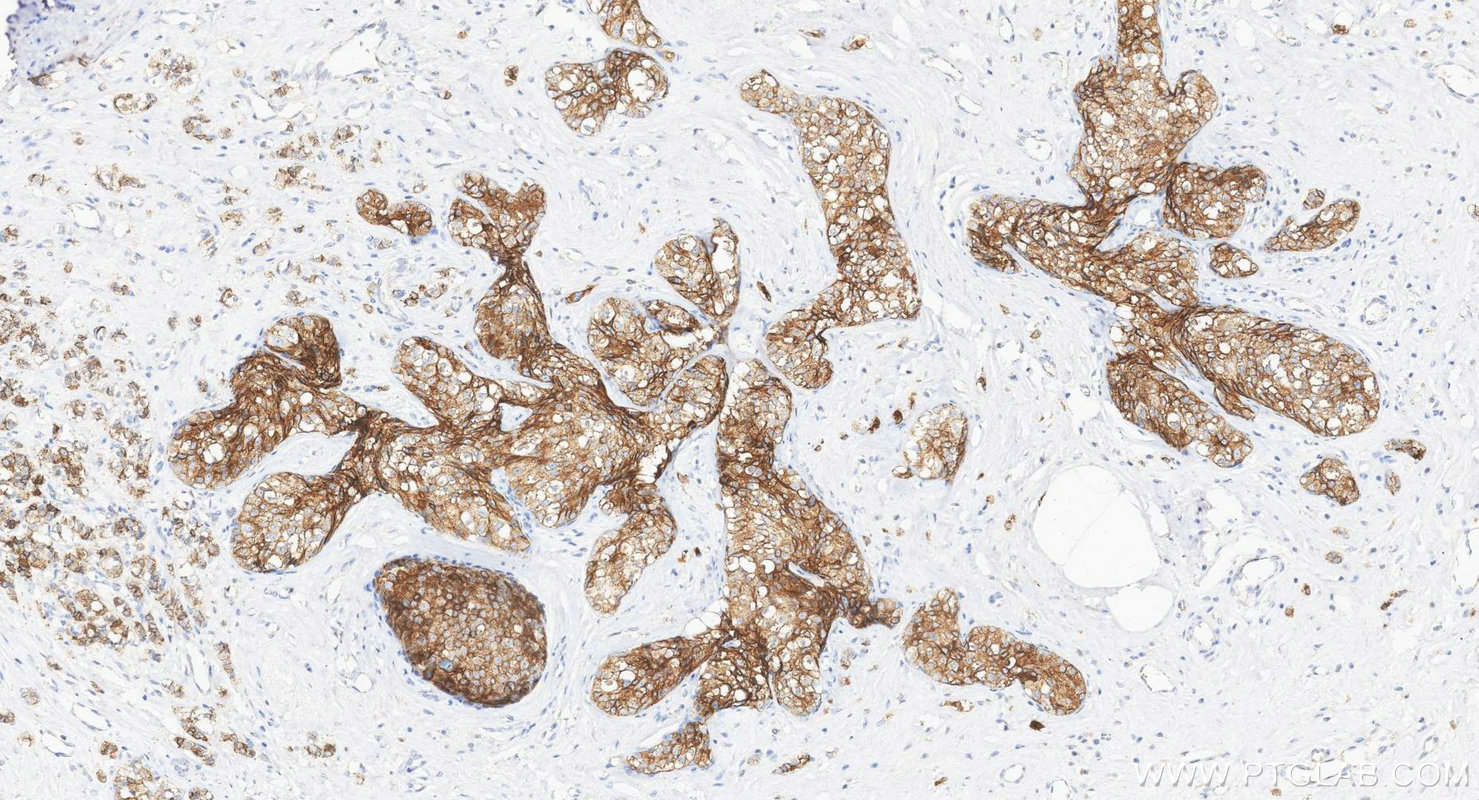 Immunohistochemistry (IHC) staining of human breast cancer tissue using MUC1/CA15-3 Monoclonal antibody (60749-1-Ig)