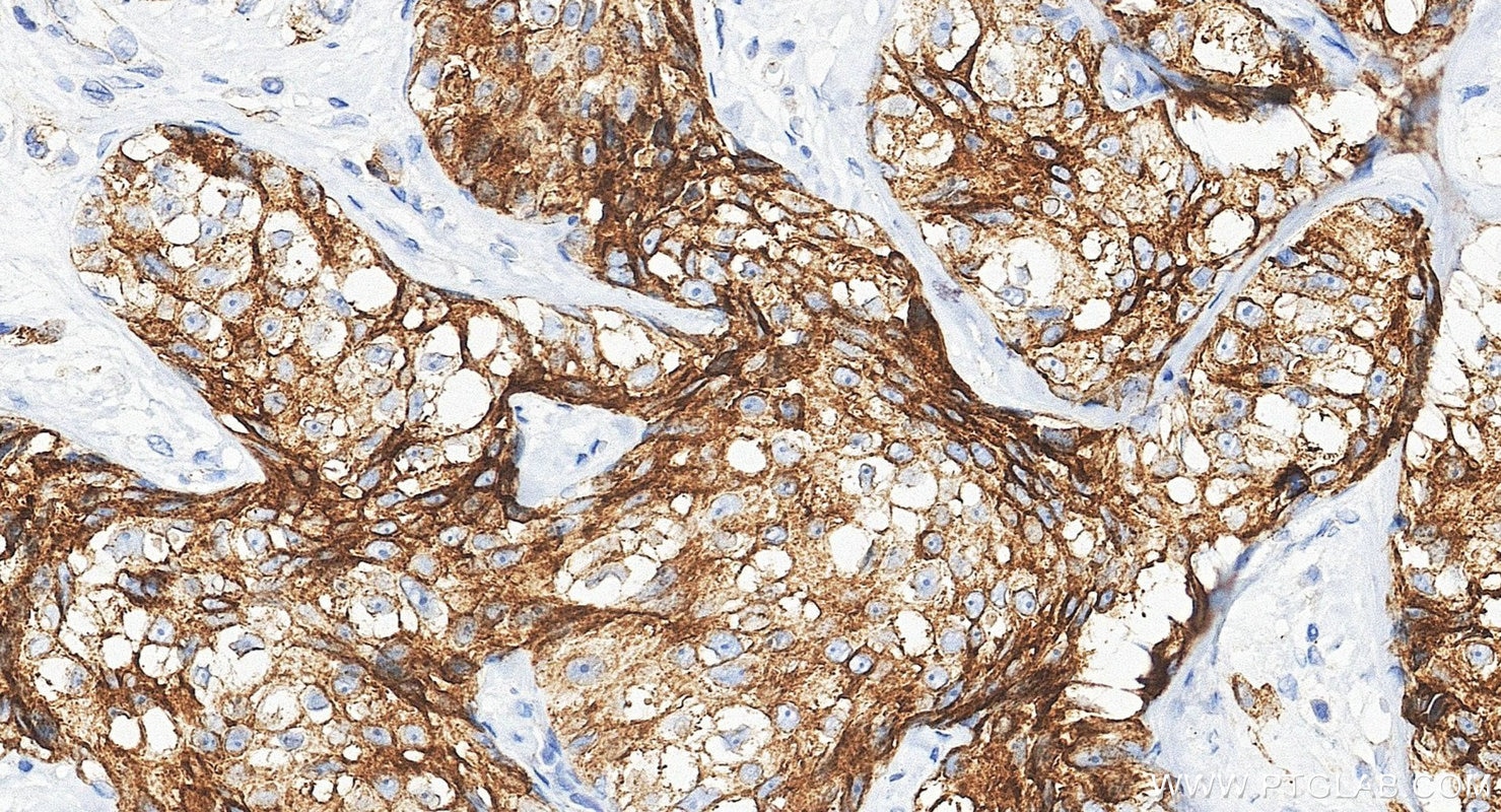 Immunohistochemistry (IHC) staining of human breast cancer tissue using MUC1/CA15-3 Monoclonal antibody (60749-1-Ig)