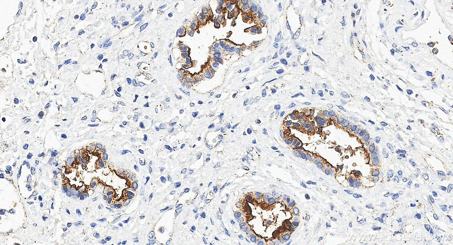 Immunohistochemistry (IHC) staining of human liver cancer tissue using MUC1/CA15-3 Monoclonal antibody (60749-1-Ig)