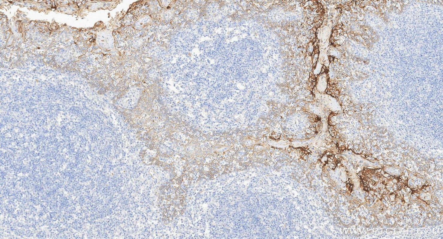 Immunohistochemistry (IHC) staining of human tonsillitis tissue using MUC1/CA15-3 Monoclonal antibody (60749-1-Ig)