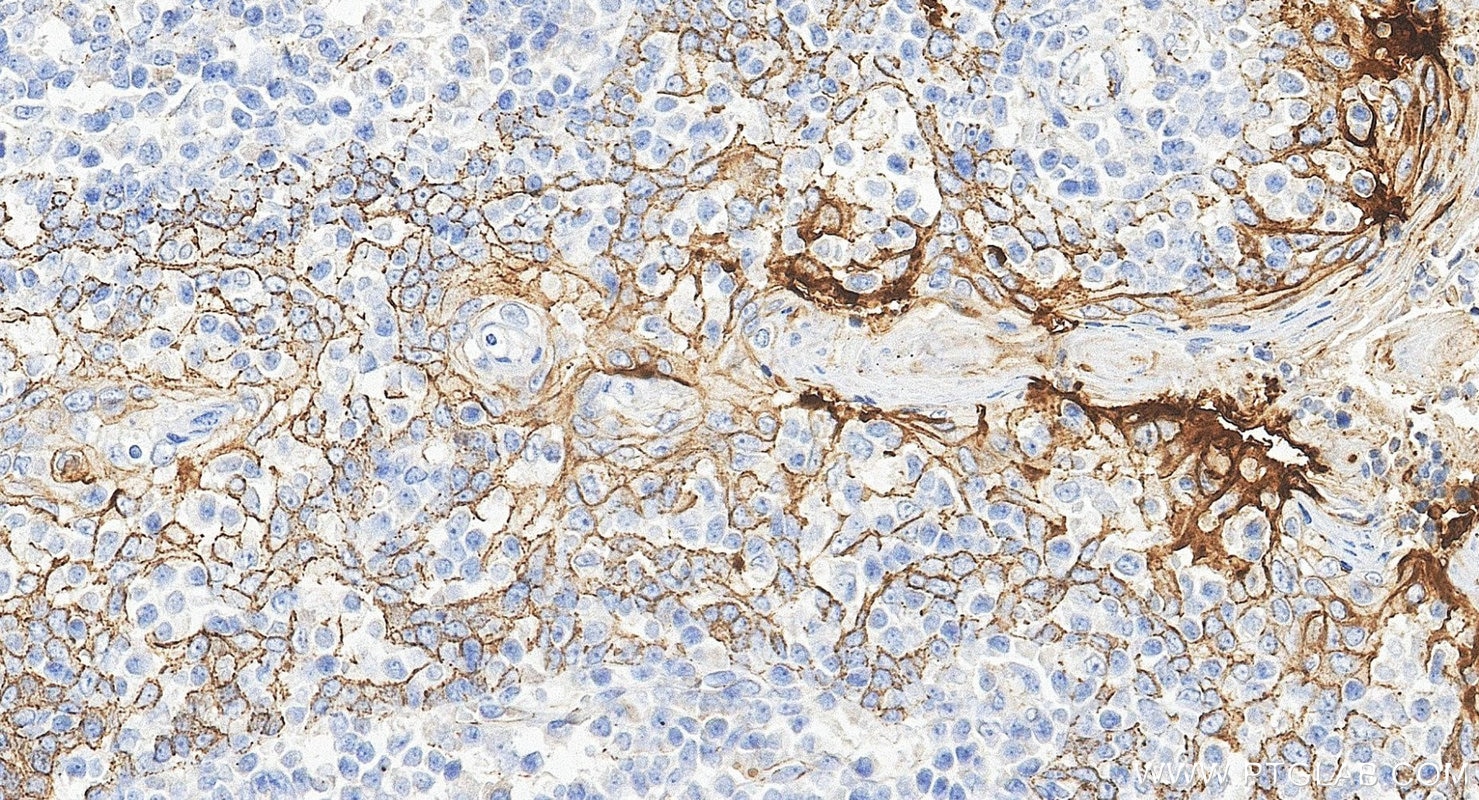 Immunohistochemistry (IHC) staining of human tonsillitis tissue using MUC1/CA15-3 Monoclonal antibody (60749-1-Ig)