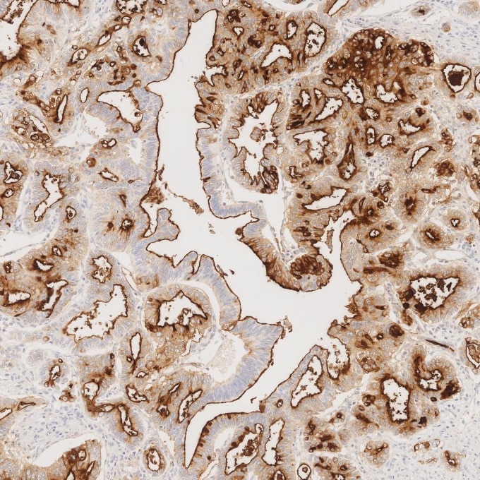 IHC staining of human pancreas cancer using 83311-4-RR Immunohistochemistry (IHC) staining of human pancreas cancer tissue using MUC1/CA15-3 C-terminal Recombinant monoclonal anti (83311-4-RR)