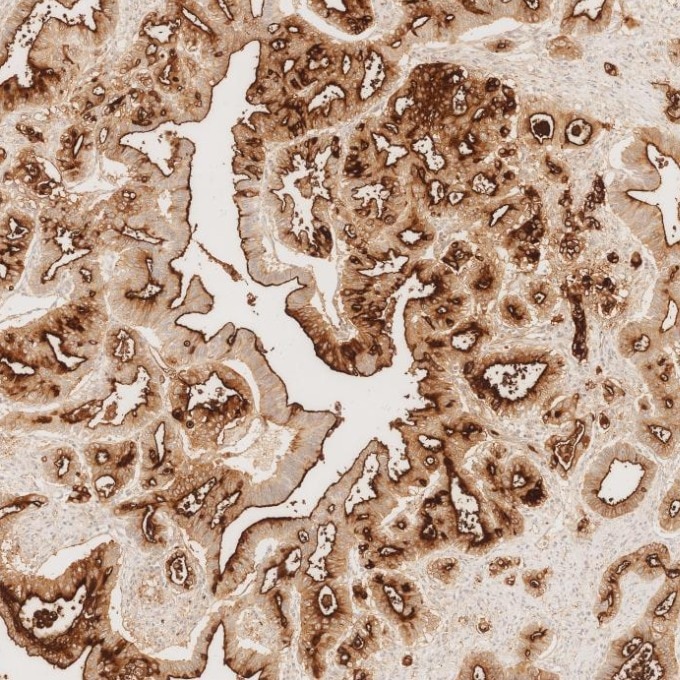 IHC staining of human pancreas cancer using 83311-4-RR Immunohistochemistry (IHC) staining of human pancreas cancer tissue using MUC1/CA15-3 C-terminal Recombinant monoclonal anti (83311-4-RR)