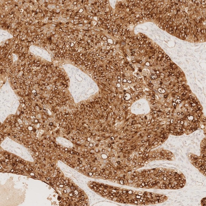 IHC staining of human ovary cancer using 83311-4-RR Immunohistochemistry (IHC) staining of human ovary cancer tissue using MUC1/CA15-3 C-terminal Recombinant monoclonal anti (83311-4-RR)