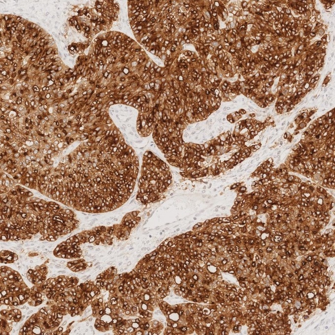 IHC staining of human ovary cancer using 83311-4-RR Immunohistochemistry (IHC) staining of human ovary cancer tissue using MUC1/CA15-3 C-terminal Recombinant monoclonal anti (83311-4-RR)