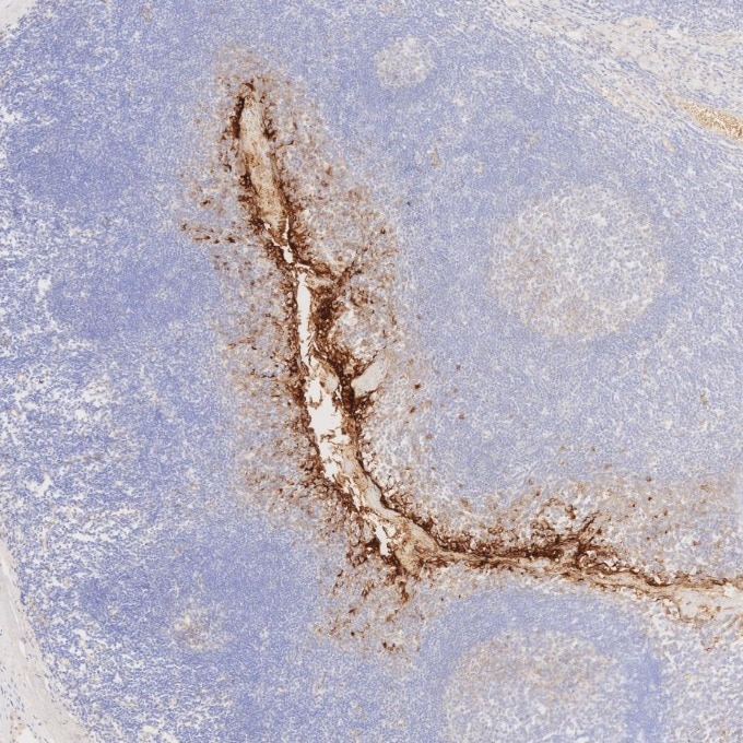 IHC staining of human tonsillitis using 83311-4-RR Immunohistochemistry (IHC) staining of human tonsillitis tissue using MUC1/CA15-3 C-terminal Recombinant monoclonal anti (83311-4-RR)
