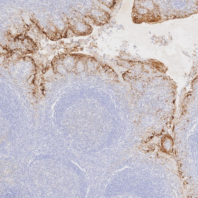 IHC staining of human tonsillitis using 83311-4-RR Immunohistochemistry (IHC) staining of human tonsillitis tissue using MUC1/CA15-3 C-terminal Recombinant monoclonal anti (83311-4-RR)