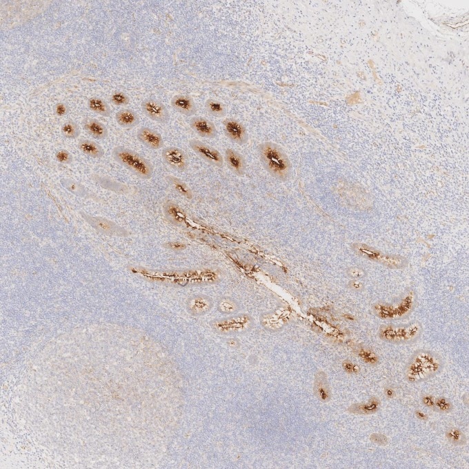 IHC staining of human appendicitis using 83311-4-RR Immunohistochemistry (IHC) staining of human appendicitis tissue using MUC1/CA15-3 C-terminal Recombinant monoclonal anti (83311-4-RR)