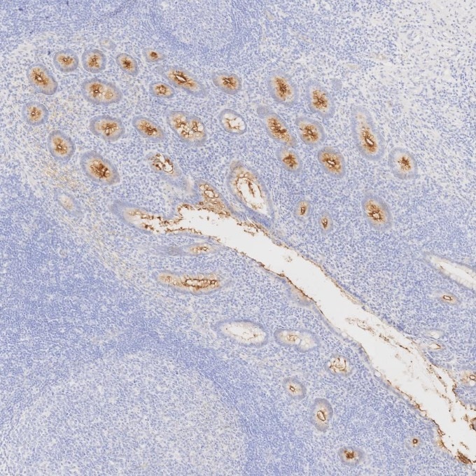 IHC staining of human appendicitis using 83311-4-RR Immunohistochemistry (IHC) staining of human appendicitis tissue using MUC1/CA15-3 C-terminal Recombinant monoclonal anti (83311-4-RR)