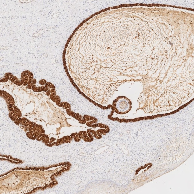 IHC staining of human cervix using 83311-4-RR Immunohistochemistry (IHC) staining of human cervix tissue using MUC1/CA15-3 C-terminal Recombinant monoclonal anti (83311-4-RR)
