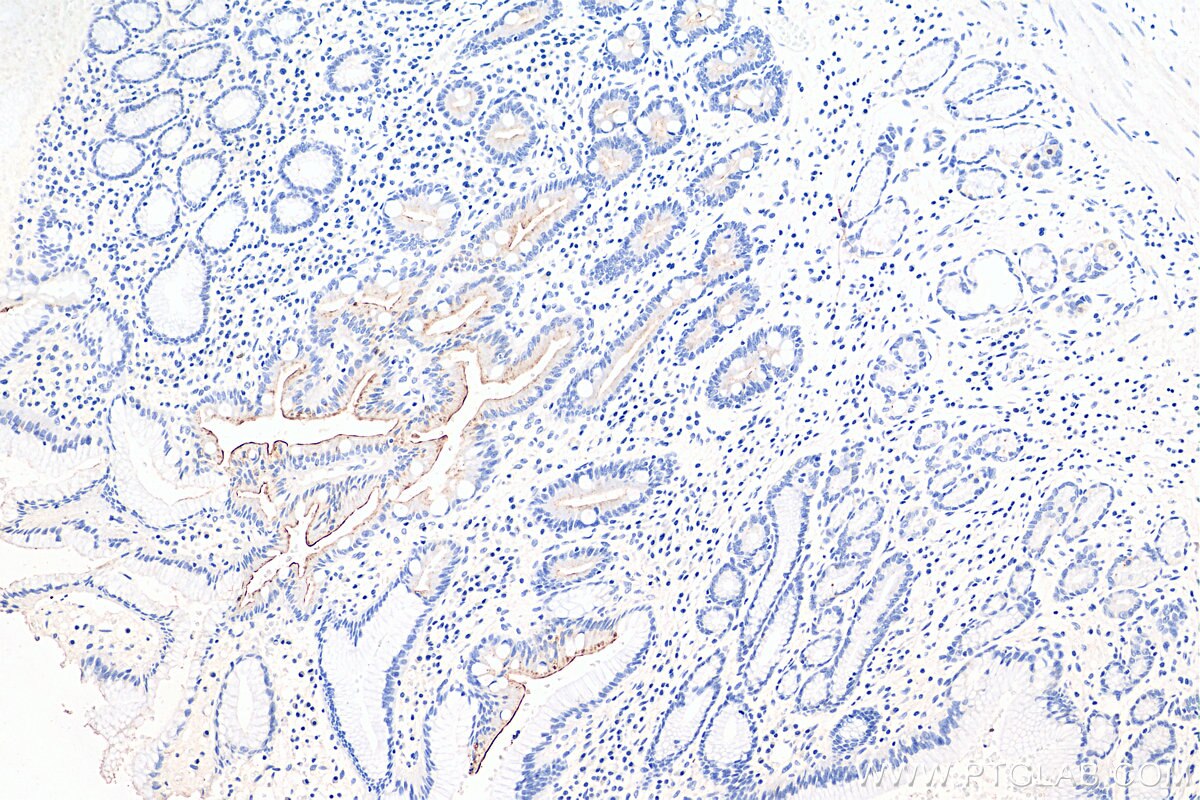 IHC staining of human stomach cancer using 29832-1-AP