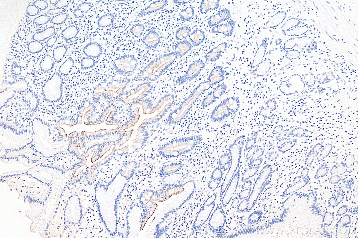 Immunohistochemistry (IHC) staining of human stomach cancer tissue using MUC13 Polyclonal antibody (29832-1-AP)